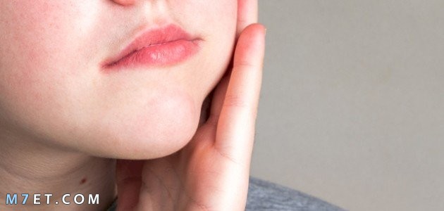 Cheek swelling factors due to molars Cheek due to molars Picture No. 4 Cheek swelling due to molars