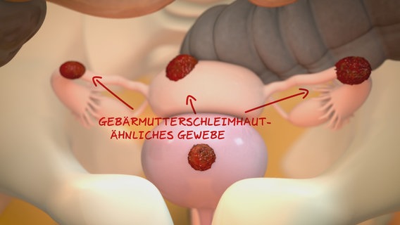 Schematic representation: Tissue similar to the uterine lining settles in the abdominal cavity. © NDR 