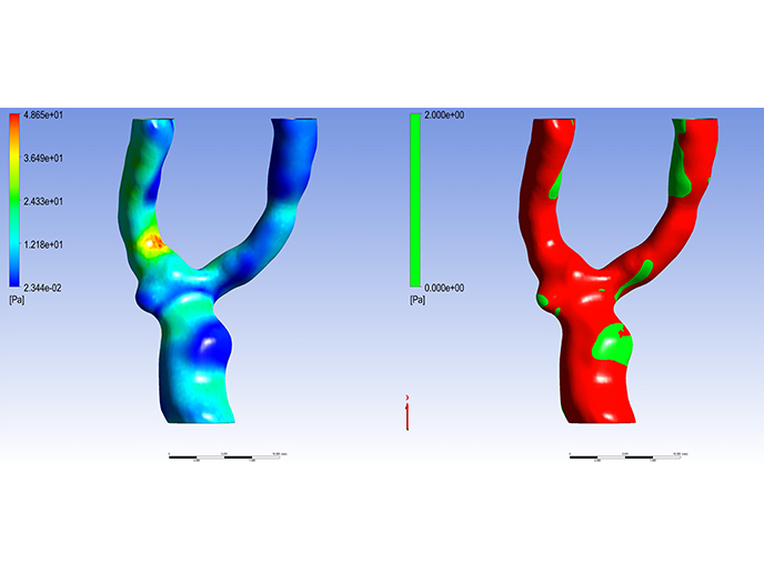 AI in personalized medicine: Better risk detection, prevention and treatment of carotid stenosis | TAXINOMISIS Project | Results in brief | H2020 | CORDIS