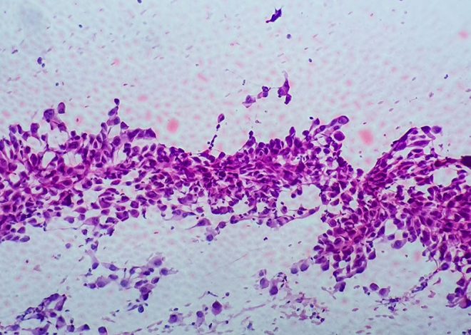 New England Journal of Medicine Publishes Primary Analysis of VISION Data for Tepotinib